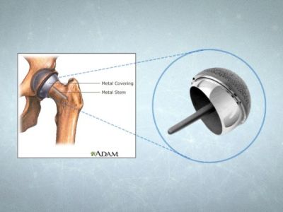 Hip Resurfacing: Older Patients vs Younger Patients