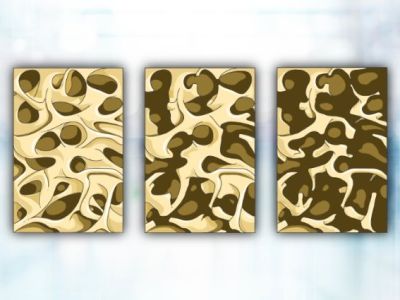 New Study Tests Osteoporosis Injections