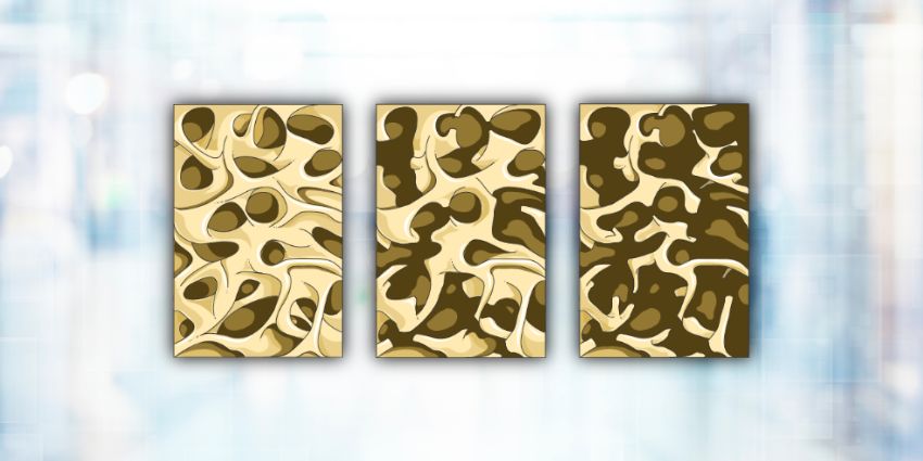 New Study Tests Osteoporosis Injections