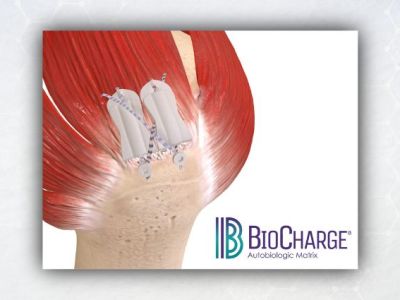 Novel Autobiologic Rotator Cuff Matrix Cleared